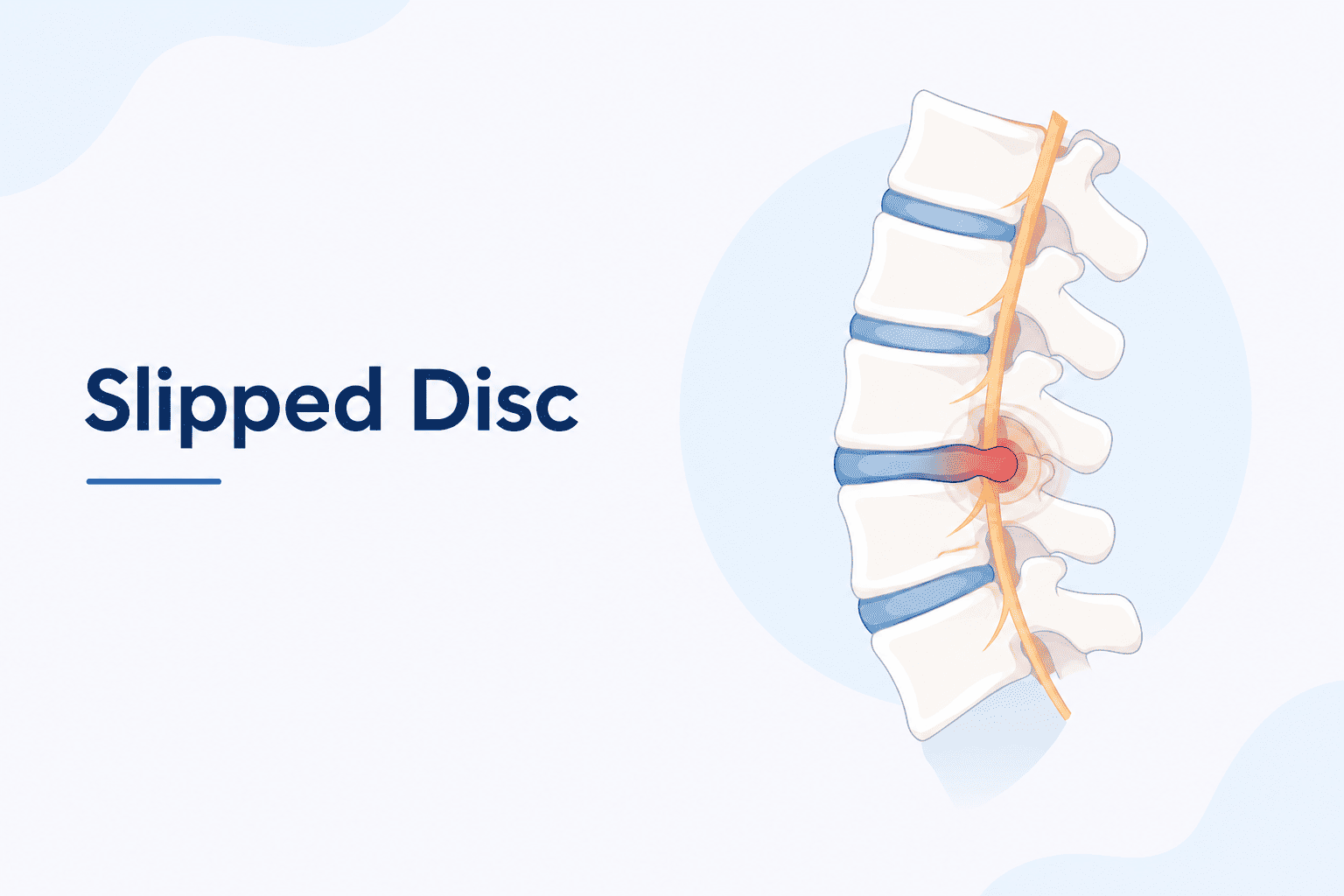 Best Doctor for Slipped Disc in Kandivali