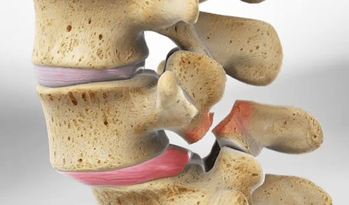 Spondylolisthesis