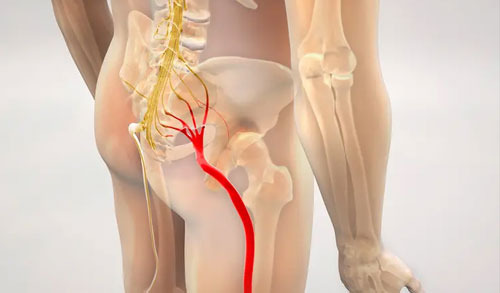 Sciatica