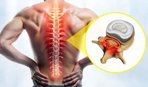Spinal Stenosis