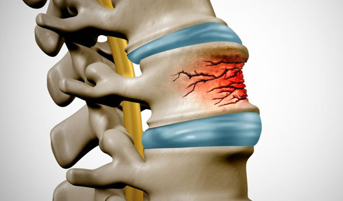 Spinal Fracture