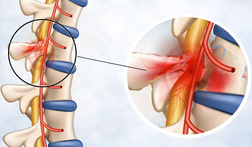 Myelopathy
