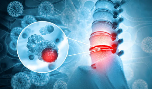 Spinal Infection
