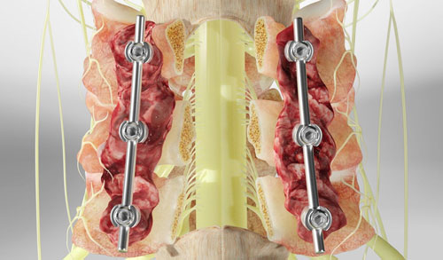 Laminectomy Decompression