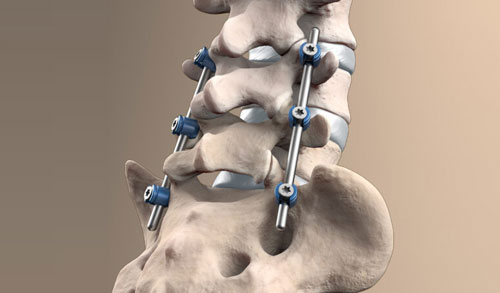 Spinal Fusion